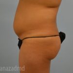 Brazilian Butt Lift Before & After Patient #1678