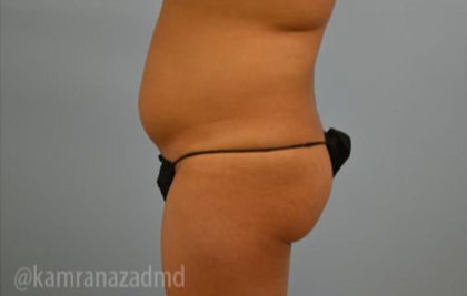 Brazilian Butt Lift Before & After Patient #1678