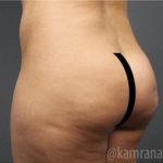 Brazilian Butt Lift Before & After Patient #1634