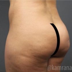 Brazilian Butt Lift Before & After Patient #1634