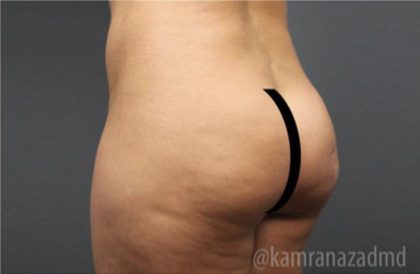 Brazilian Butt Lift Before & After Patient #1634