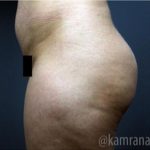 Brazilian Butt Lift Before & After Patient #1634