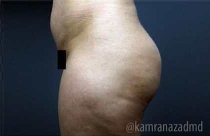 Brazilian Butt Lift Before & After Patient #1634
