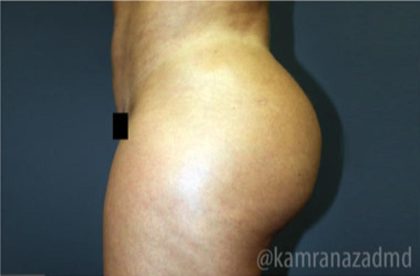 Brazilian Butt Lift Before & After Patient #1634