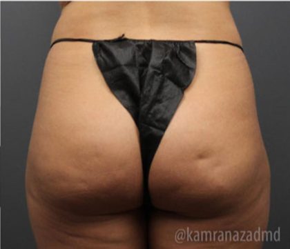 Brazilian Butt Lift Before & After Patient #1634