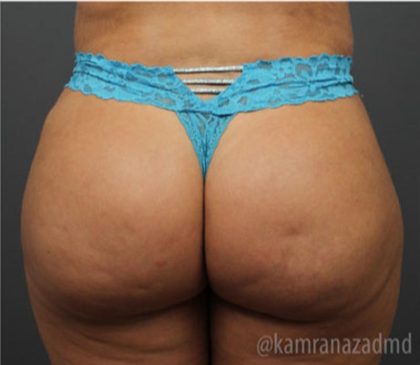 Brazilian Butt Lift Before & After Patient #1634