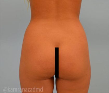 Brazilian Butt Lift Before & After Patient #1679