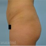 Brazilian Butt Lift Before & After Patient #1681