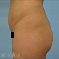 Brazilian Butt Lift Before & After Patient #1681