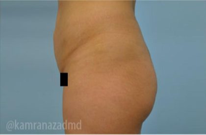 Brazilian Butt Lift Before & After Patient #1681