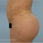 Brazilian Butt Lift Before & After Patient #1681