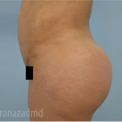 Brazilian Butt Lift Before & After Patient #1681