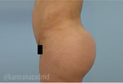 Brazilian Butt Lift Before & After Patient #1681