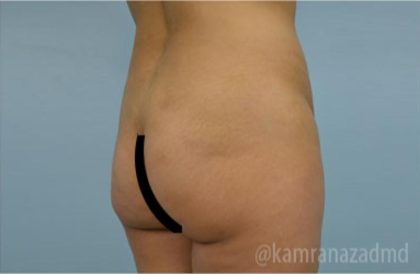Brazilian Butt Lift Before & After Patient #1681
