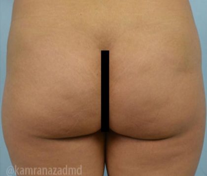 Brazilian Butt Lift Before & After Patient #1681
