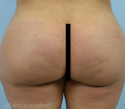 Brazilian Butt Lift Before & After Patient #1681