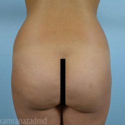 Brazilian Butt Lift Before & After Patient #1682