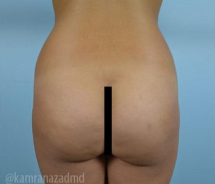 Brazilian Butt Lift Before & After Patient #1682
