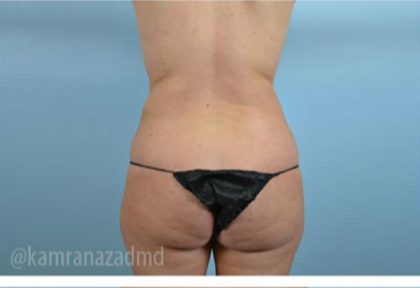 Brazilian Butt Lift Before & After Patient #1684