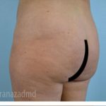 Brazilian Butt Lift Before & After Patient #1684
