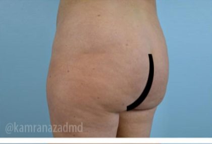Brazilian Butt Lift Before & After Patient #1684