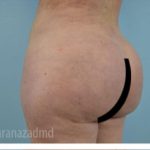 Brazilian Butt Lift Before & After Patient #1684