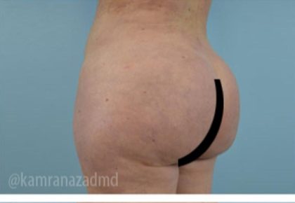 Brazilian Butt Lift Before & After Patient #1684