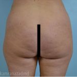 Brazilian Butt Lift Before & After Patient #1684