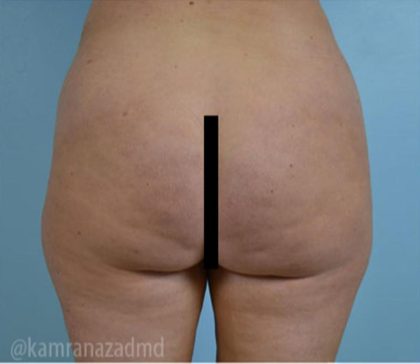 Brazilian Butt Lift Before & After Patient #1684