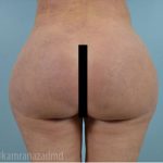 Brazilian Butt Lift Before & After Patient #1684