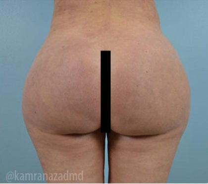 Brazilian Butt Lift Before & After Patient #1684