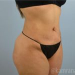 Brazilian Butt Lift Before & After Patient #1686