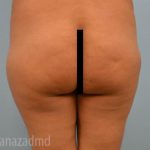 Brazilian Butt Lift Before & After Patient #1687