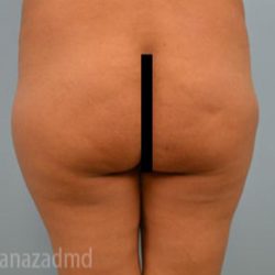 Brazilian Butt Lift Before & After Patient #1687