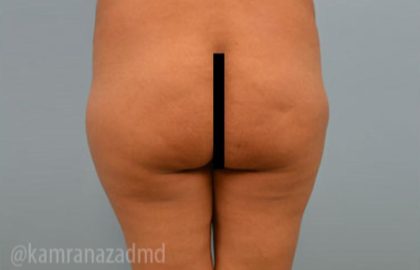Brazilian Butt Lift Before & After Patient #1687