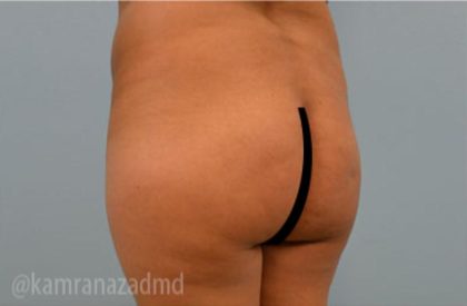 Brazilian Butt Lift Before & After Patient #1687