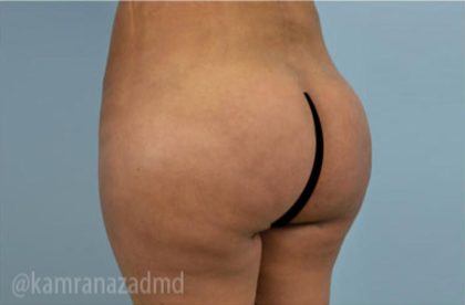 Brazilian Butt Lift Before & After Patient #1687