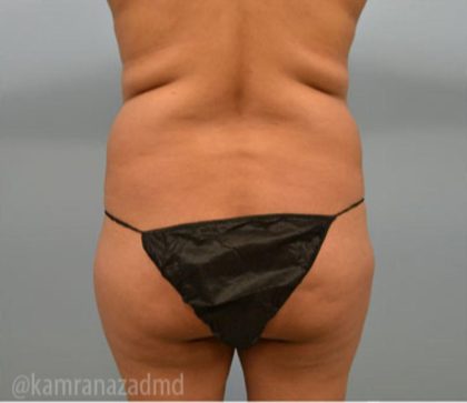 Brazilian Butt Lift Before & After Patient #1687