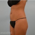 Brazilian Butt Lift Before & After Patient #1691