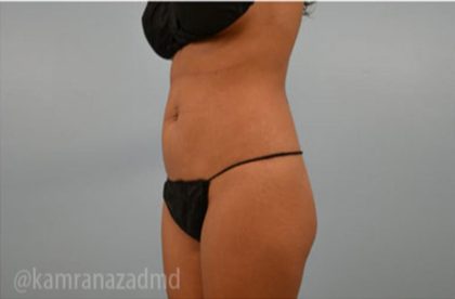 Brazilian Butt Lift Before & After Patient #1691