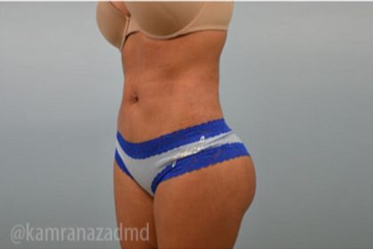 Brazilian Butt Lift Before & After Patient #1691