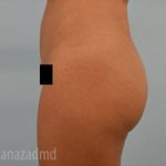 Brazilian Butt Lift Before & After Patient #1691
