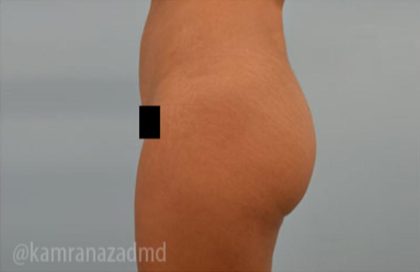 Brazilian Butt Lift Before & After Patient #1691