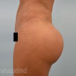 Brazilian Butt Lift Before & After Patient #1691