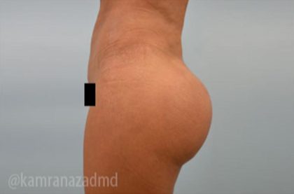 Brazilian Butt Lift Before & After Patient #1691