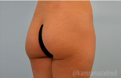 Brazilian Butt Lift Before & After Patient #1691