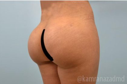 Brazilian Butt Lift Before & After Patient #1691