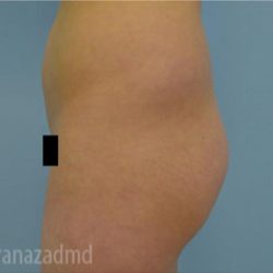 Brazilian Butt Lift Before & After Patient #1692