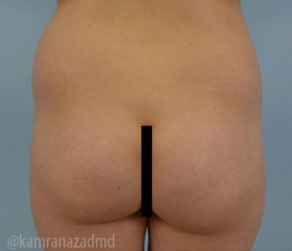 Brazilian Butt Lift Before & After Patient #1692