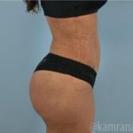 Brazilian Butt Lift Before & After Patient #1636